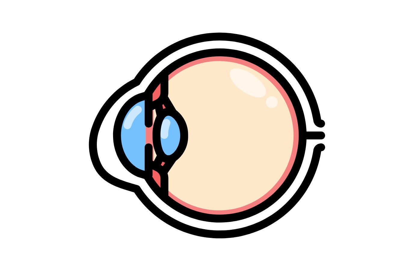 Keratoconus Diagram