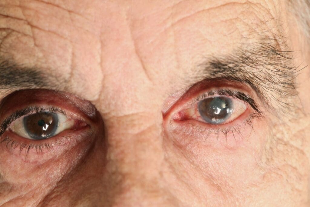 Older man with glaucoma