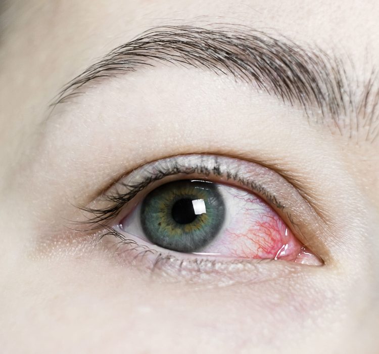 Close up of a severe bloodshot red eye. Viral Blepharitis, Conjunctivitis, Adenoviruses. Irritated or infected eye